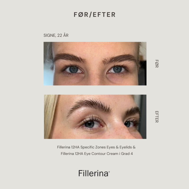 Før/efter resultater med Fillerina 12HA Specific Zones Eyes & Eyelids og Fillerina 12HA Eye Contour Cream i Grad 4