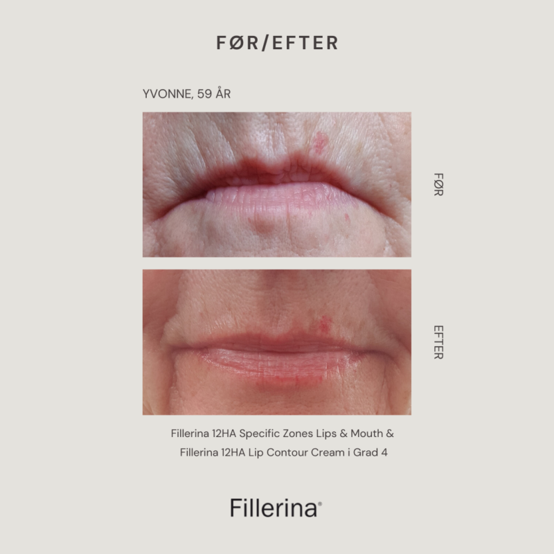 Før/efter resultater med Fillerina 12HA Specific Zones Lips & Mouth og Fillerina 12HA Lip Contour Cream i Grad 4.